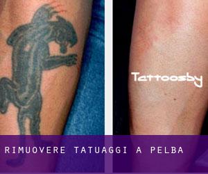 Rimuovere Tatuaggi a Pelba