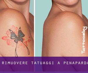 Rimuovere Tatuaggi a Peñaparda