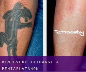 Rimuovere Tatuaggi a Pentaplátanon