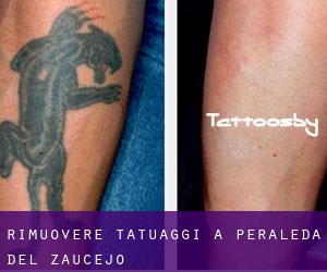 Rimuovere Tatuaggi a Peraleda del Zaucejo