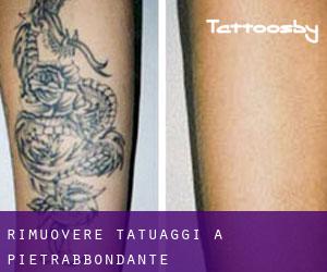 Rimuovere Tatuaggi a Pietrabbondante