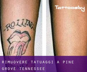 Rimuovere Tatuaggi a Pine Grove (Tennessee)