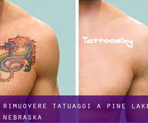 Rimuovere Tatuaggi a Pine Lake (Nebraska)