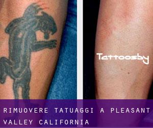 Rimuovere Tatuaggi a Pleasant Valley (California)