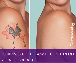 Rimuovere Tatuaggi a Pleasant View (Tennessee)