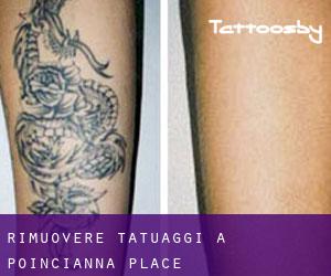 Rimuovere Tatuaggi a Poincianna Place
