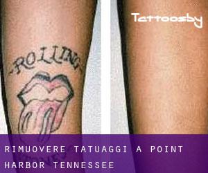 Rimuovere Tatuaggi a Point Harbor (Tennessee)