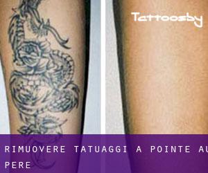 Rimuovere Tatuaggi a Pointe-au-Père