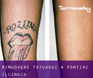 Rimuovere Tatuaggi a Pontiac (Illinois)