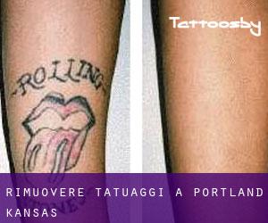 Rimuovere Tatuaggi a Portland (Kansas)