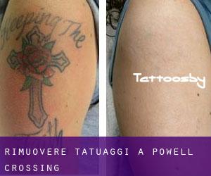 Rimuovere Tatuaggi a Powell Crossing