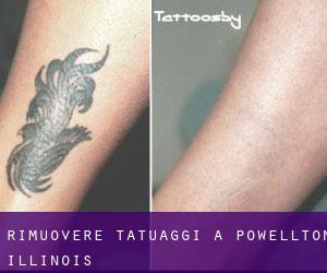 Rimuovere Tatuaggi a Powellton (Illinois)