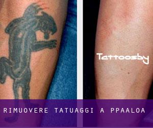 Rimuovere Tatuaggi a Pāpa‘aloa
