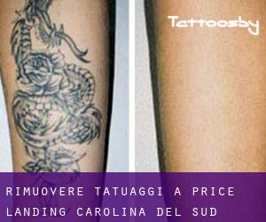 Rimuovere Tatuaggi a Price Landing (Carolina del Sud)