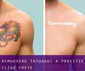 Rimuovere Tatuaggi a Profítis Ilías (Crete)