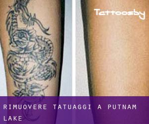 Rimuovere Tatuaggi a Putnam Lake