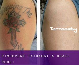 Rimuovere Tatuaggi a Quail Roost