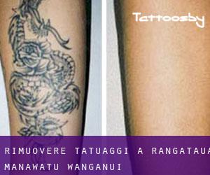 Rimuovere Tatuaggi a Rangataua (Manawatu-Wanganui)