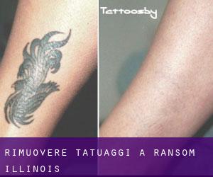 Rimuovere Tatuaggi a Ransom (Illinois)