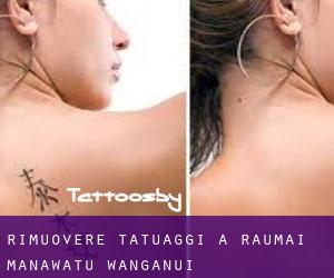 Rimuovere Tatuaggi a Raumai (Manawatu-Wanganui)