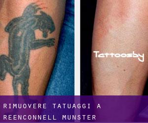 Rimuovere Tatuaggi a Reenconnell (Munster)