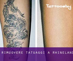 Rimuovere Tatuaggi a Rhineland