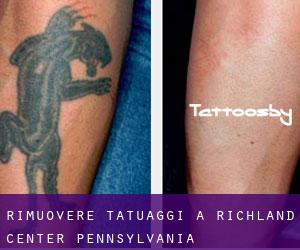 Rimuovere Tatuaggi a Richland Center (Pennsylvania)