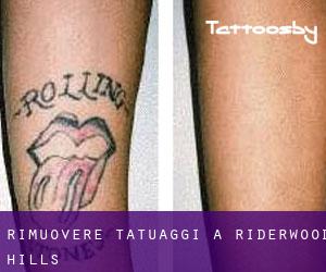 Rimuovere Tatuaggi a Riderwood Hills