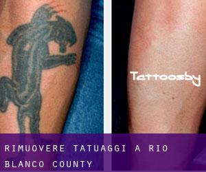 Rimuovere Tatuaggi a Rio Blanco County