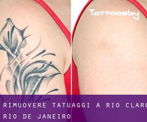 Rimuovere Tatuaggi a Rio Claro (Rio de Janeiro)