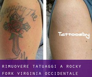 Rimuovere Tatuaggi a Rocky Fork (Virginia Occidentale)