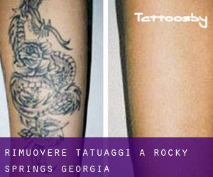 Rimuovere Tatuaggi a Rocky Springs (Georgia)