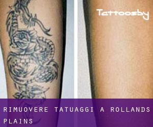 Rimuovere Tatuaggi a Rollands Plains