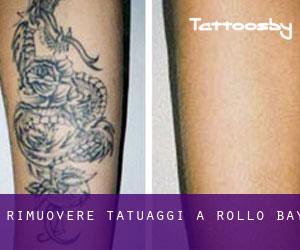 Rimuovere Tatuaggi a Rollo Bay