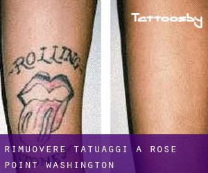 Rimuovere Tatuaggi a Rose Point (Washington)