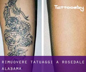 Rimuovere Tatuaggi a Rosedale (Alabama)