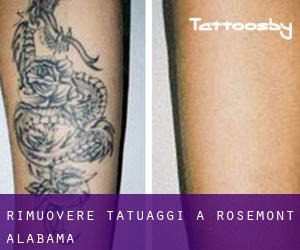 Rimuovere Tatuaggi a Rosemont (Alabama)