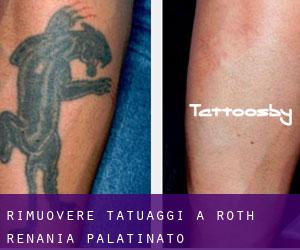 Rimuovere Tatuaggi a Roth (Renania-Palatinato)