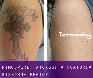 Rimuovere Tatuaggi a Ruatoria (Gisborne Region)