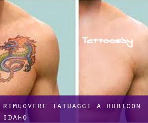 Rimuovere Tatuaggi a Rubicon (Idaho)