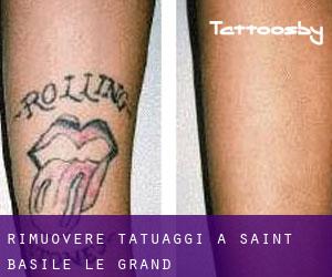 Rimuovere Tatuaggi a Saint-Basile-le-Grand