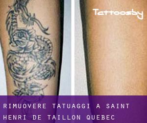 Rimuovere Tatuaggi a Saint-Henri-de-Taillon (Quebec)