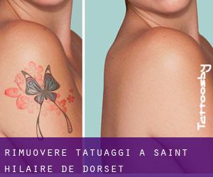 Rimuovere Tatuaggi a Saint-Hilaire-de-Dorset
