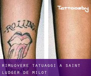 Rimuovere Tatuaggi a Saint-Ludger-de-Milot