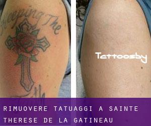 Rimuovere Tatuaggi a Sainte-Thérèse-de-la-Gatineau