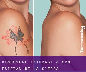 Rimuovere Tatuaggi a San Esteban de la Sierra