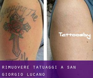 Rimuovere Tatuaggi a San Giorgio Lucano