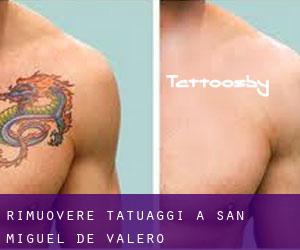 Rimuovere Tatuaggi a San Miguel de Valero