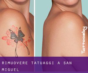 Rimuovere Tatuaggi a San Miguel