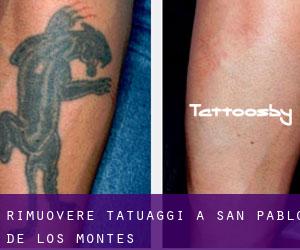 Rimuovere Tatuaggi a San Pablo de los Montes